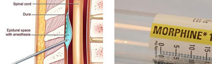 Sex-Reassignment-Surgery-with-Pain-management