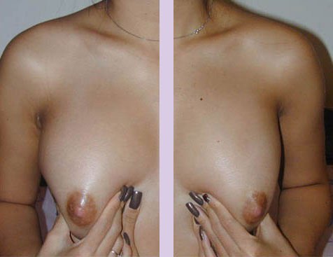 After-Breast-implant-surgery-350-cc-front-with-breast-massage