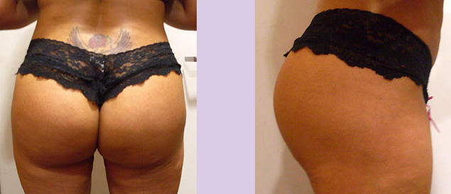 After-Buttock-implant-surgery-330-cc--by-doctor-Chettawut