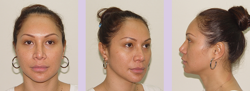 After-Jaw-and-Chin-contouring--case-1-by-Chettawut-MD