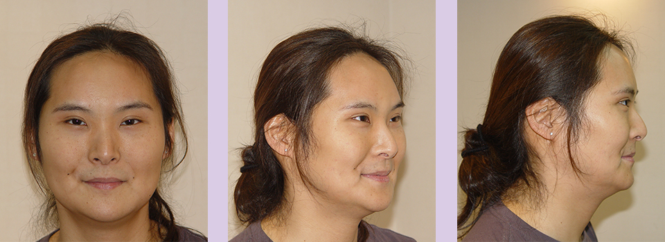 After-Jaw-and-Chin-contouring--case-2-by-Chettawut-MD