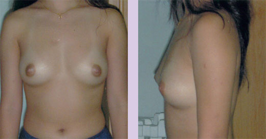 Before-Breast-implant-surgery-350-cc-by-Dr.Chettawut