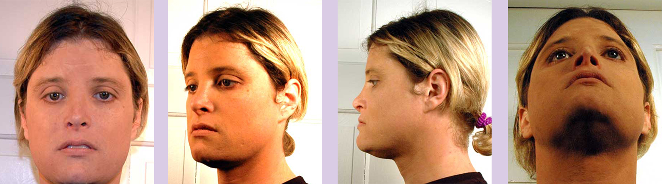 Before-Cheek-bone-implant-surgery-by-Chettawut-MD