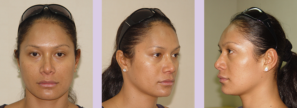 Before-Jaw-and-Chin-contouring--case-1-by-Chettawut-MD
