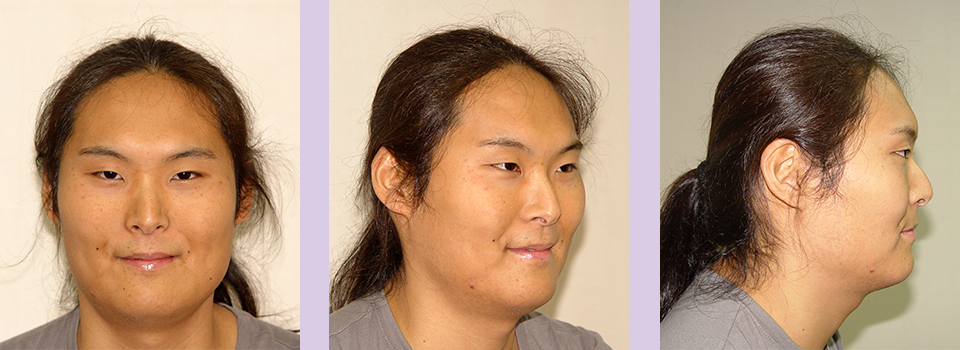 Before-Jaw-and-Chin-contouring--case-2-by-Chettawut-MD
