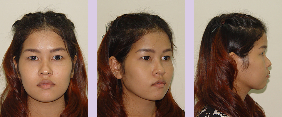 Before-augmentation-rhinoplasty-by-Chettawut-MD