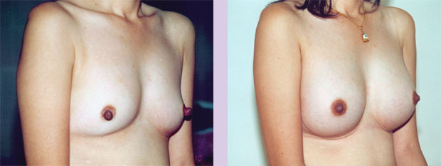 Breast-implant-surgery-320-cc-45-degree-view-by-Dr.Chettawut-Bangkok-Thailand