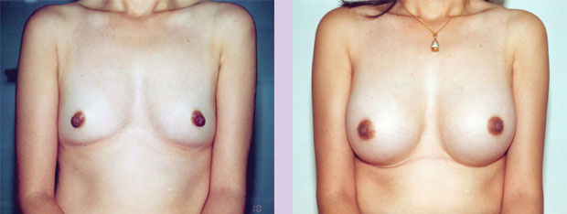 Breast-implant-surgery-320-cc-front-view-by-Dr.Chettawut-Bangkok-Thailand