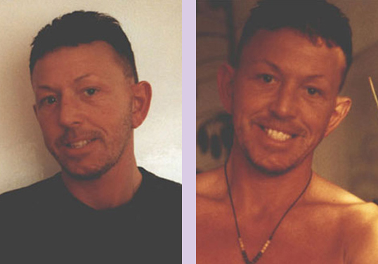 Brow-lift-and-Face-lift-surgery--Doctor-Chettawut-face-and-body-contouring-gallery-after-surgery