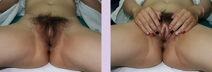 Case-2-Gender-reassignment-surgery-by-Dr.-Chettawut