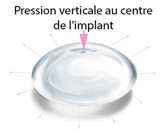 Comment faire le bon massage du sein pour prévenir les seins durs après une chirurgie d'augmentation mammaire