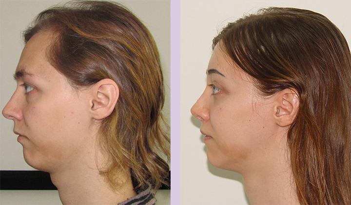 Cosmetic-facial-implant-surgery-by-doctor-Chettawut-Gallery-Case-1-before-and-after-cheek-implant-and-FFS-surgery-2