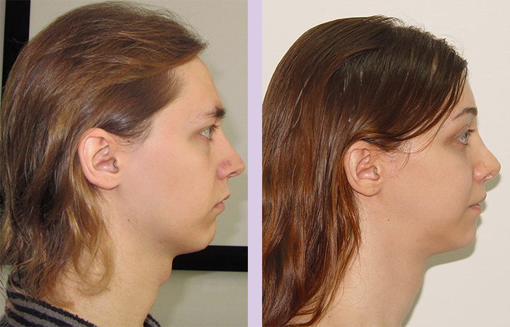 Cosmetic-facial-implant-surgery-by-doctor-Chettawut-Gallery-Case-1-before-and-after-cheek-implant-and-FFS-surgery-3