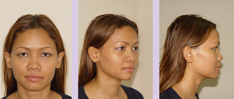 Cosmetic-facial-implant-surgery-by-doctor-Chettawut-Gallery-Case-2-before-nose-implant-and-alarplasty-surgery