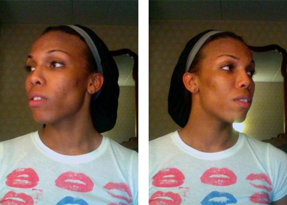 Doctor-Chettawut--facial-feminization-work-jaw-contouring-before-surgery