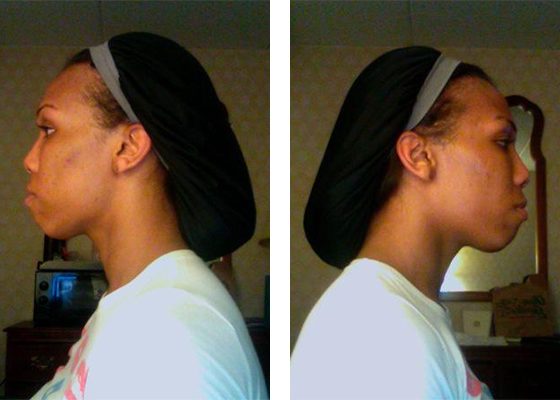 Doctor-Chettawut--facial-feminization-work-jaw-contouring-before1-surgery