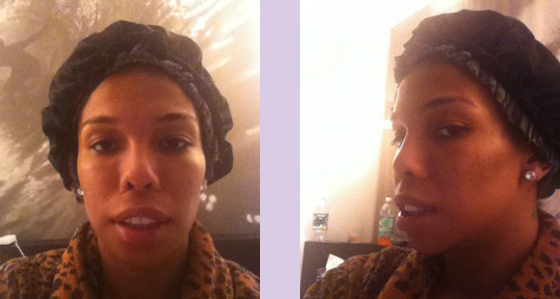 Doctor-Chettawut-full-facial-feminization-work-jaw-contouring-after-surgery