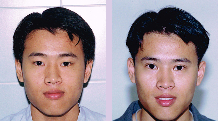 Double-eyelid-surgery-for-Asian--Doctor-Chettawut-facial-cosmetic-surgery-gallery-case-3