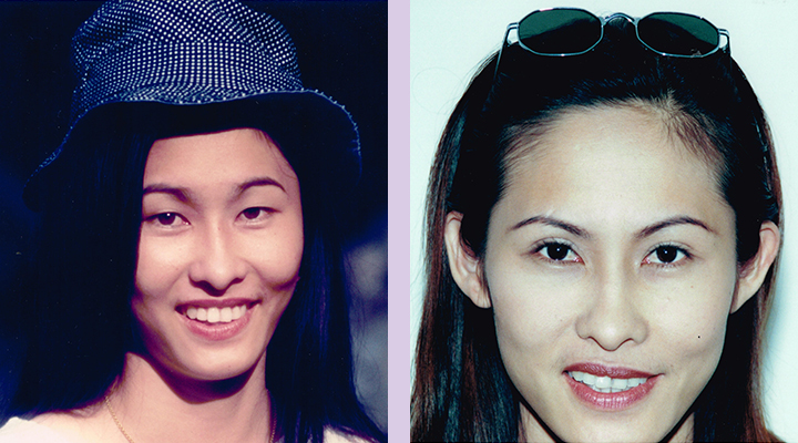 Double-eyelid-surgery-for-Asian--Doctor-Chettawut-facial-cosmetic-surgery-gallery-case1