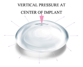 Dr.-Chettawut's-Breast-massage-technique-after-breast-implant-surgery