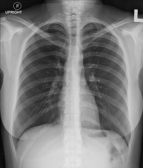 Example-of-chest-x-ray