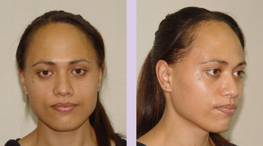 FFS3-Brow-bone-bossing-reduction+Jaw-and-Chin-contouring-surgery-before 