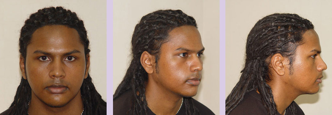 Facial-chin-implant-surgery-by-doctor-Chettawut-after