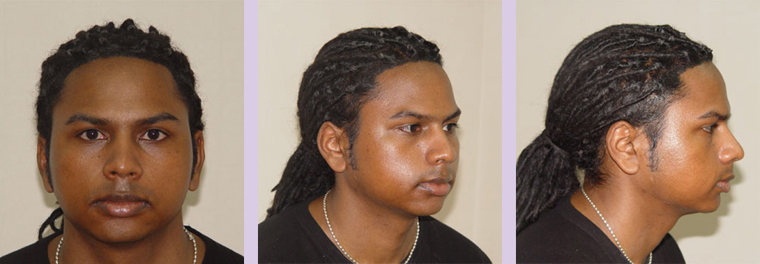 Facial-chin-implant-surgery-by-doctor-Chettawut-before