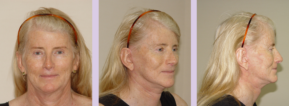 Facial-feminization-and-Face-lift-surgery--Doctor-Chettawut-facial-cosmetic-surgery-gallery-after