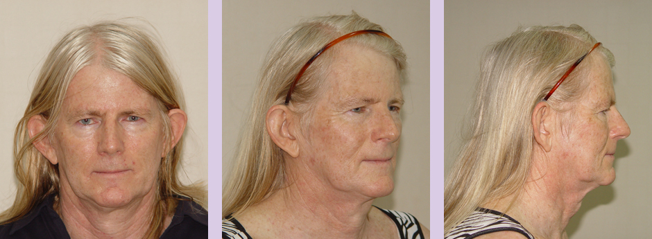 Facial-feminization-and-Face-lift-surgery--Doctor-Chettawut-facial-cosmetic-surgery-gallery-before