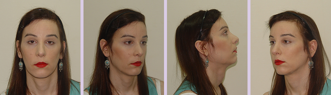 Facial-feminization-for-forehead-and-nose-(Dr.Chettawut-FFS-after-surgery)