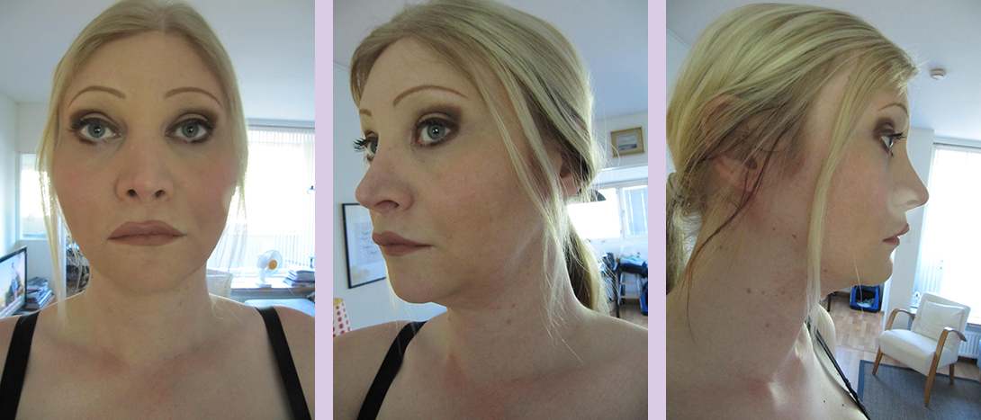 Facial-feminization-surgery-by-doctor-Chettawut-Gallery 4-1-after-surgery