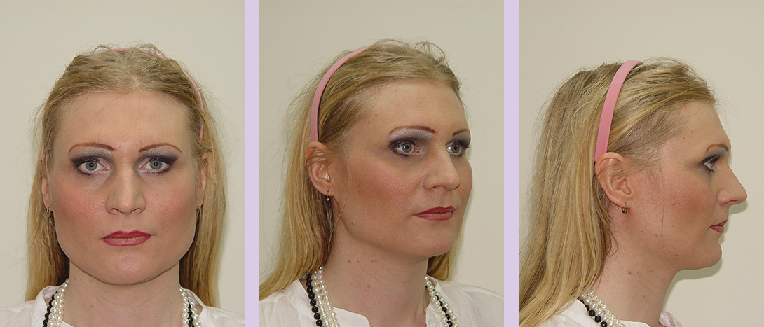 Facial-feminization-surgery-by-doctor-Chettawut-Gallery 4-1-before-surgery