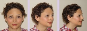 Quite Dr peter raphael facial feminization was specially Think, Dr peter raphael facial feminization