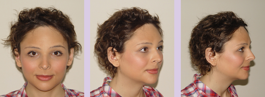 Facial-feminization-surgery-by-doctor-Chettawut-Gallery-A1-after