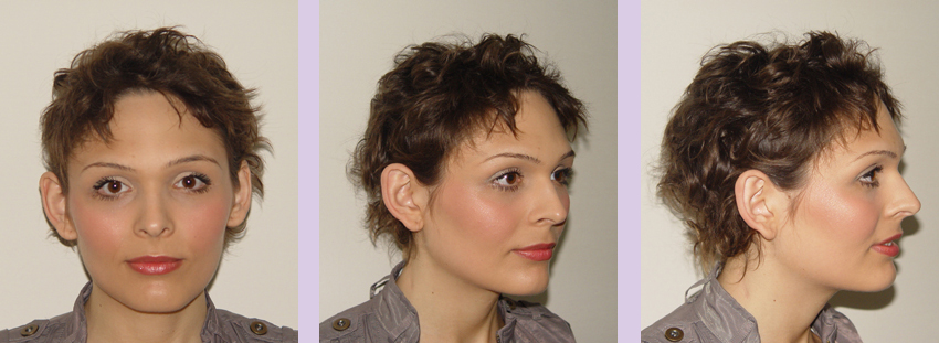 Facial-feminization-surgery-by-doctor-Chettawut-Gallery-A1-before