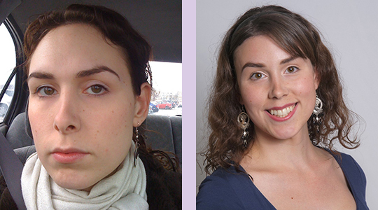 Facial-feminization-surgery-by-doctor-Chettawut-Gallery-A2-before-and-after