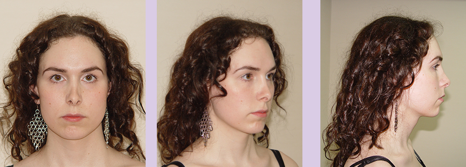 Facial-feminization-surgery-by-doctor-Chettawut-Gallery-A2-before