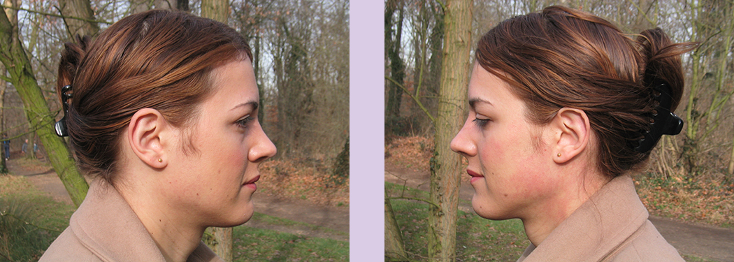 Facial-feminization-surgery-by-doctor-Chettawut-Gallery-B-2-after-1