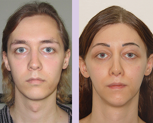 Facial-feminization-surgery-by-doctor-Chettawut-Gallery-B-3-before-and-after-1