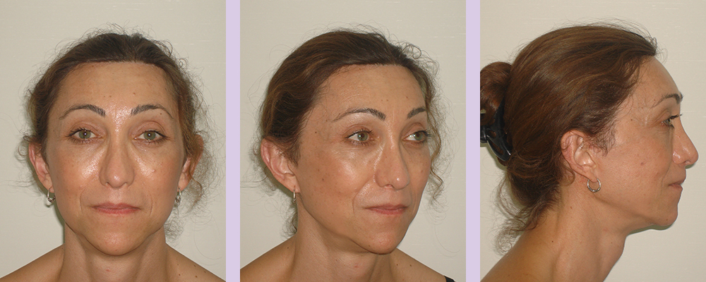 Facial-feminization-surgery-by-doctor-Chettawut-Gallery-B-4-after