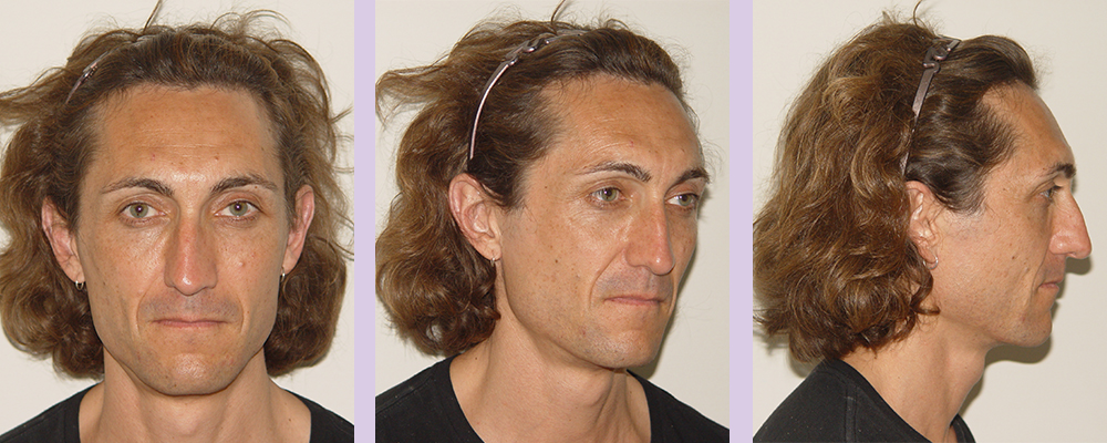 Facial-feminization-surgery-by-doctor-Chettawut-Gallery-B-4-before