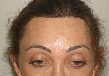 Facial-feminization-surgery-by-doctor-Chettawut-Gallery-B-4-hair-line-scar-after-surgery