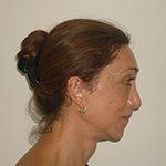 Facial-feminization-surgery-by-doctor-Chettawut-Gallery-B-4-thumbnail case 4