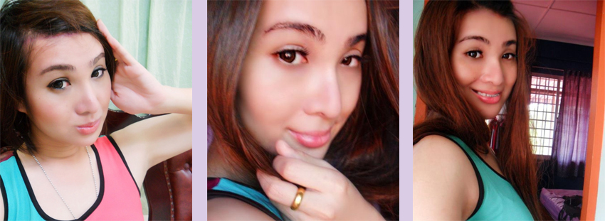 Facial-feminization-surgery-by-doctor-Chettawut-Gallery-C-1-after-surgery