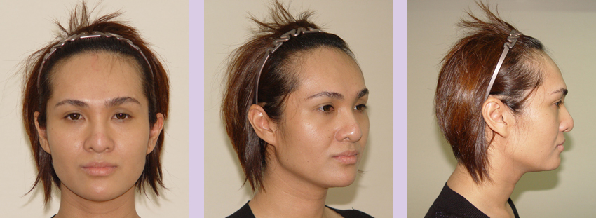 Facial-feminization-surgery-by-doctor-Chettawut-Gallery-C-1-before-surgery