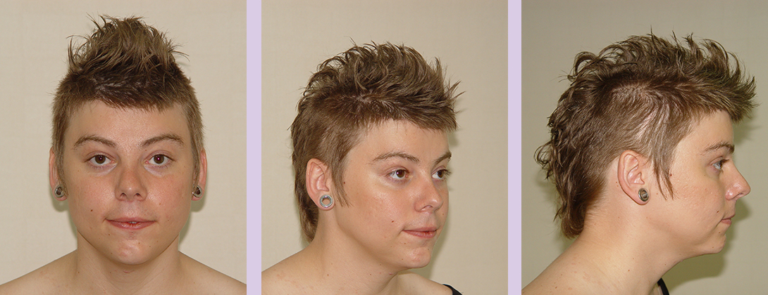 Facial-feminization-surgery-by-doctor-Chettawut-Gallery-C-2-after-surgery