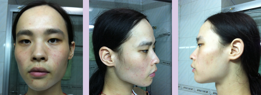 Facial-feminization-surgery-by-doctor-Chettawut-Gallery-C-3-before-surgery