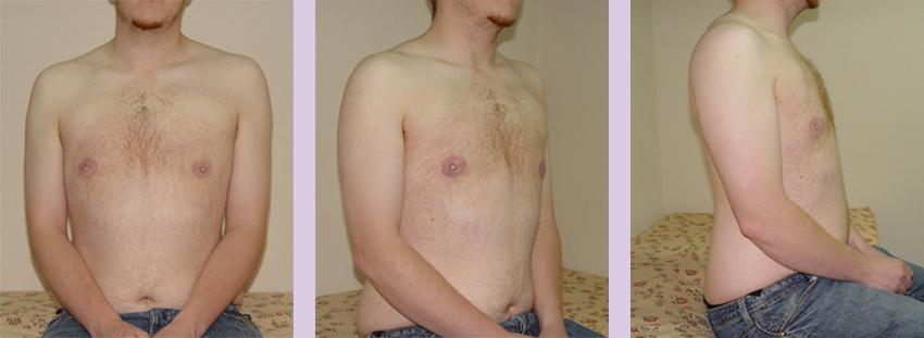 Female-to-Male-top-surgery-by-doctor-Chettawut-Gallery--after-total-breast-removal-surgery