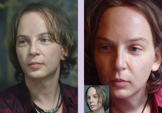 Forehead-brow-lift-surgery--Doctor-Chettawut-face-and-body-contouring-gallery-after-surgery